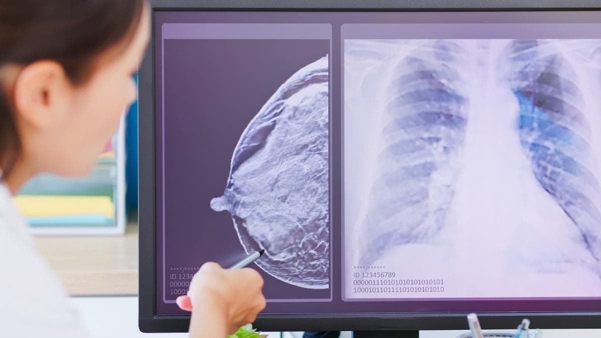 El cáncer de mama en mujeres jóvenes aumenta en las últimas décadas y preocupa a los especialistas